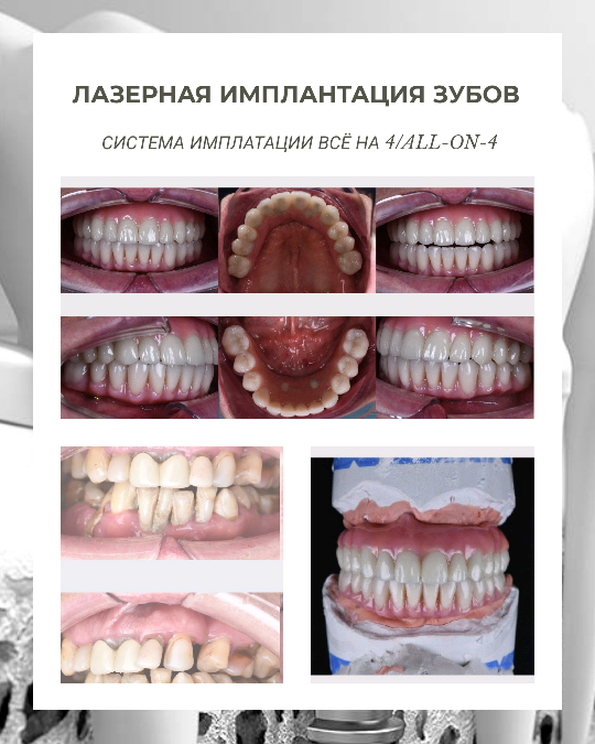 имплантация зубов +на 4 имплантах