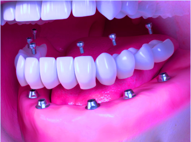 базальная имплантация зубов альтернатива