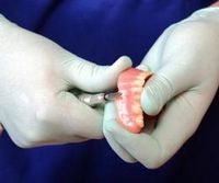 Протезирование после удаления зубов - сроки, через какое время можно делать