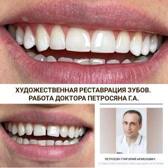 эстетическая реставрация зубов фото до и после	