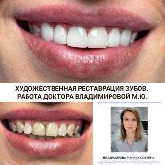 реставрация зубов композитным материалом фото