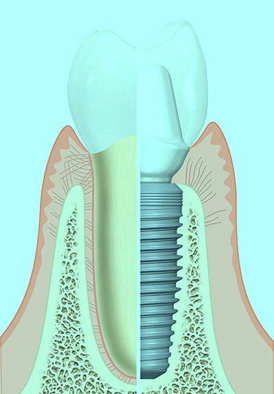 имплантация зубов возраст