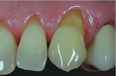 клиновидный дефект зубовм